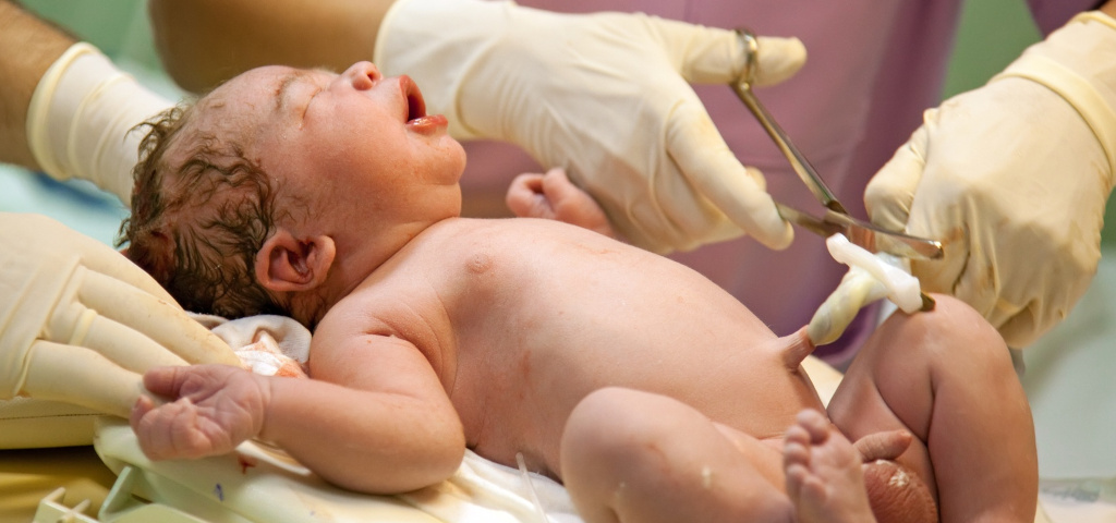 Taglio del cordone ombelicale subito dopo il parto, momento in cui è possibile raccogliere il sangue cordonale ricco di cellule staminali.