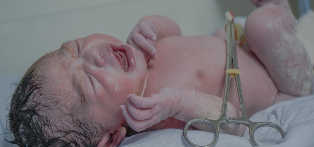 Neonato con cordone ombelicale clampato dopo raccolta del sangue cordonale per conservazione delle cellule staminali ematopoietiche