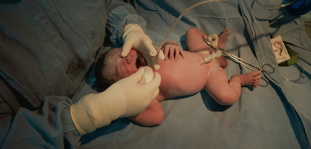 neonato con cordone ombelicale cellule staminali cordone ombelicale conservazione sangue cordonale