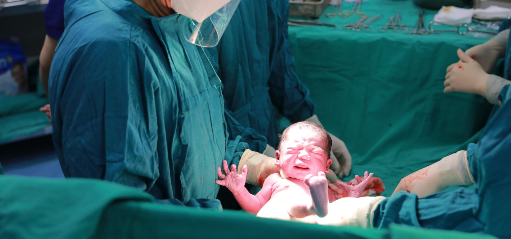 Neonato durante il parto prima della raccolta delle cellule staminali del cordone ombelicale